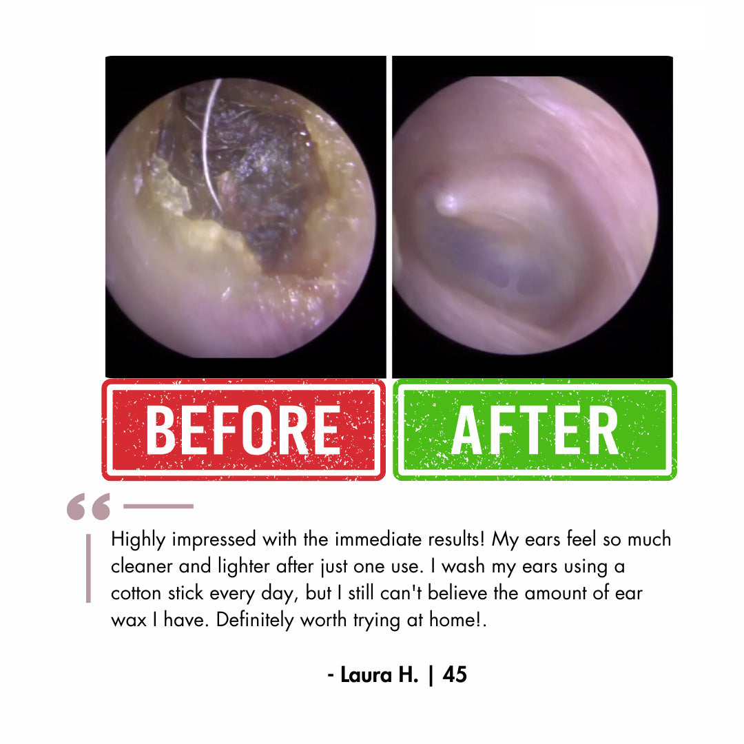 LUUNAE™ Ear Wax Remover