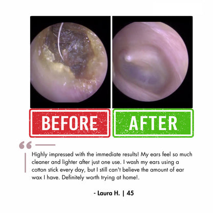 LUUNAE™ Ear Wax Remover